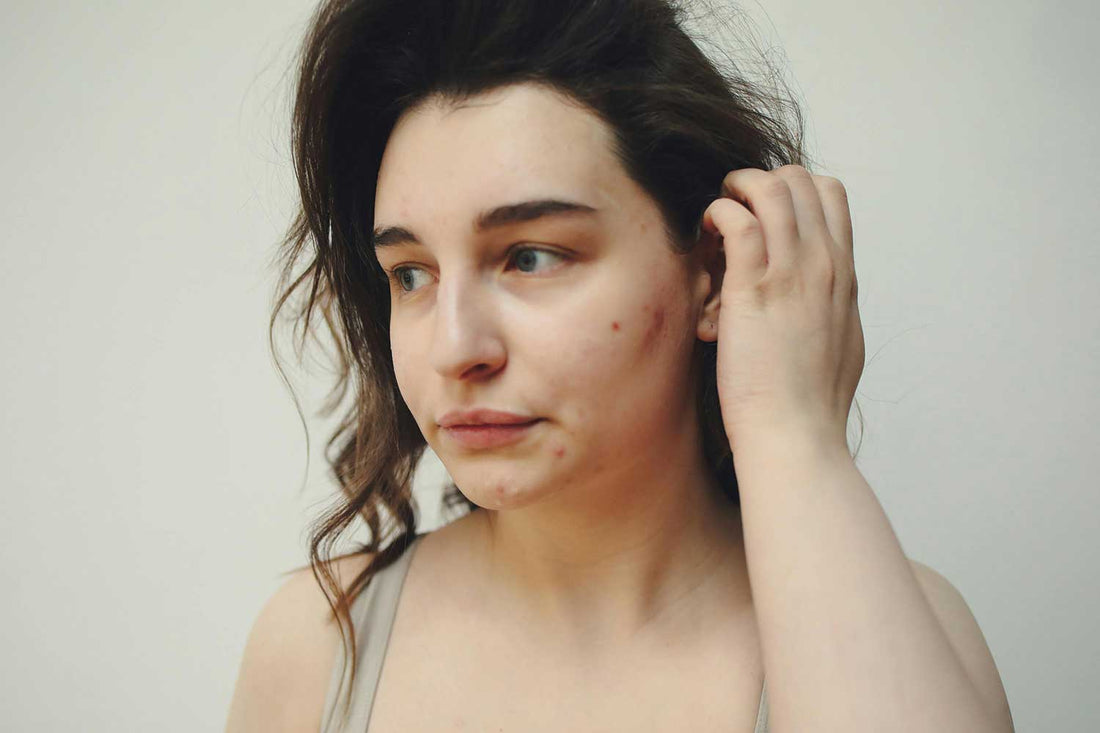  A concerned young woman with acne looks away, highlighting the need for effective skincare solutions.